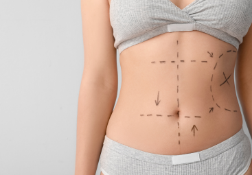 Kunnen medische gewichtsverliesbehandelingen liposuctie vervangen? | LIPOELASTIC